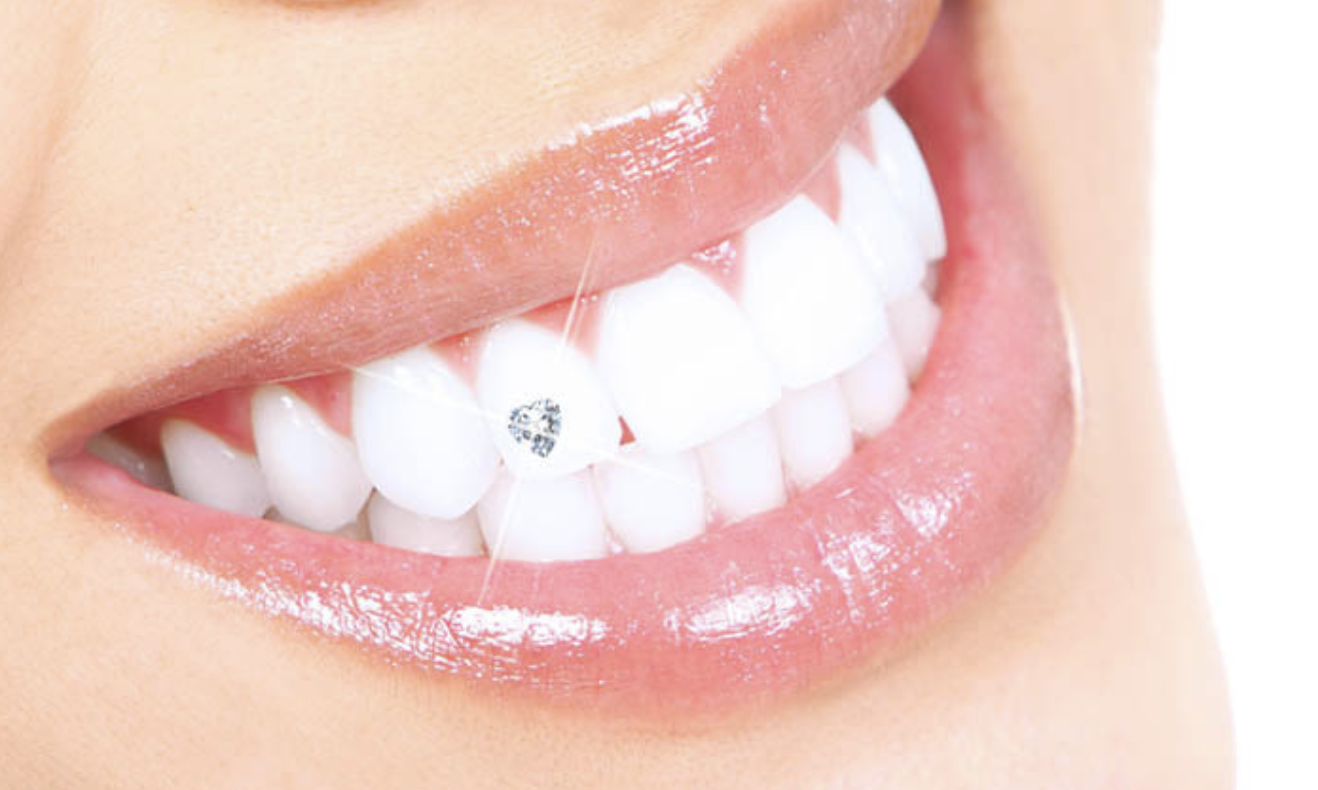 Formation en ligne strass dentaire
